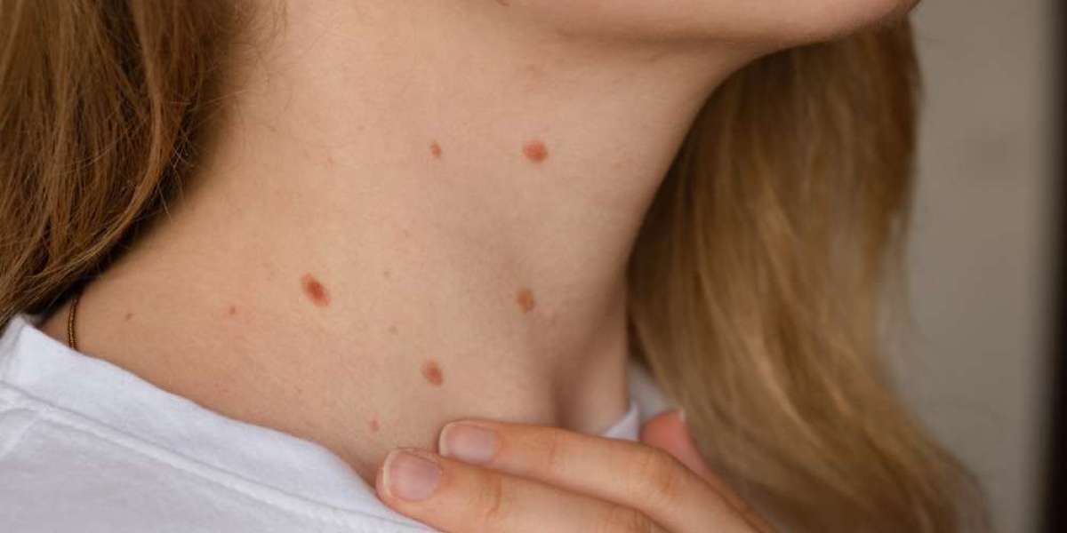 Are Skin Tags Contagious? Tips for Safe Skin Care