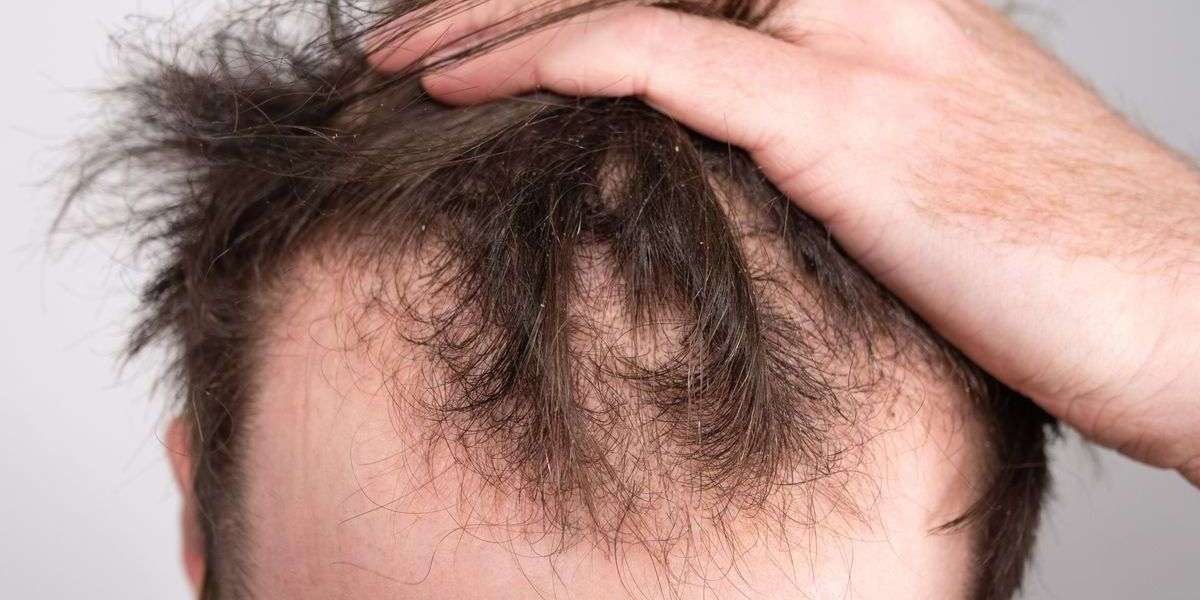 Hair Transplant Solutions for Stronger, Fuller Hairlines