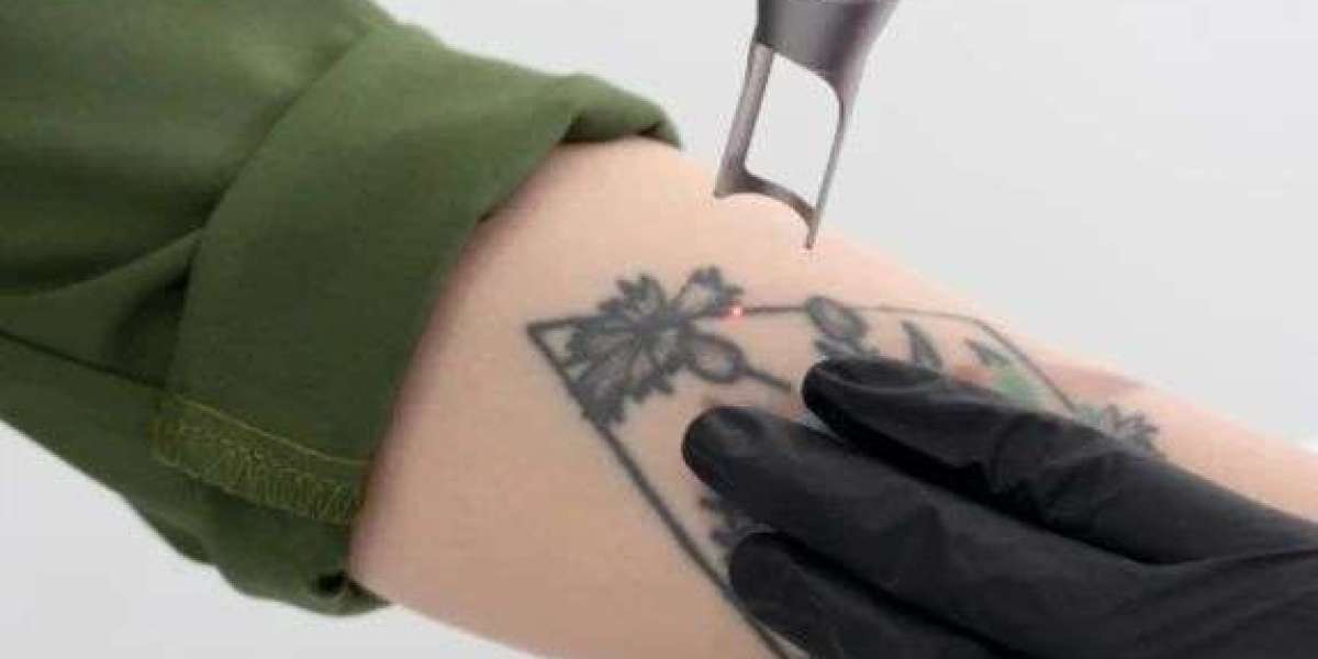 Laser Tattoo Removal Backed by Expertise & Care