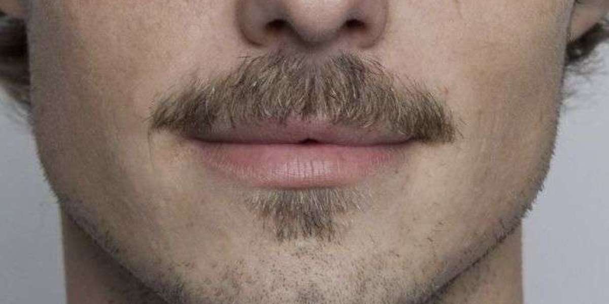Mustache Hair Transplant That Blends Perfectly with Beard Hair | Royal Clinic