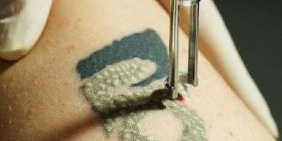 Laser Tattoo Removal Focused on Precision & Safety