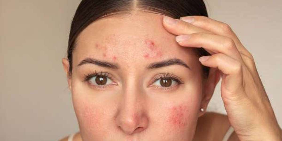 Laser Acne Treatment Tips for Best Outcomes