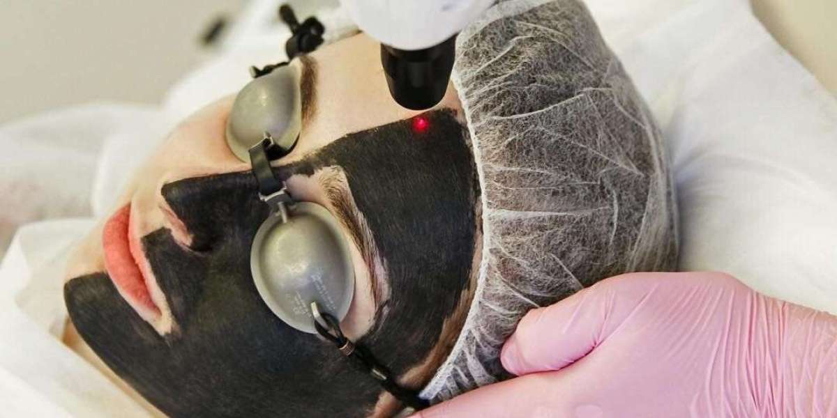 Laser Carbon Peel Therapy for Deep Skin Purification