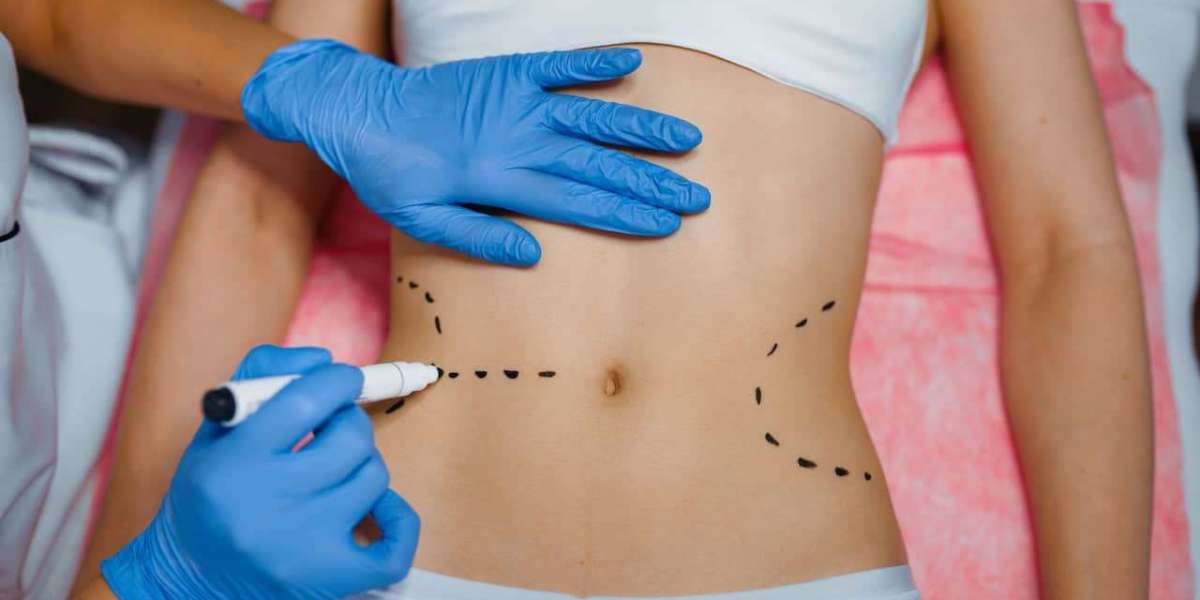 Preparing for Liposuction: Essential Do’s and Don’ts