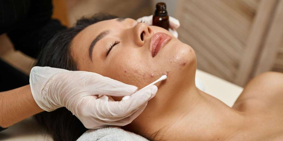 Best Acne Treatment Facial Near Me Guide