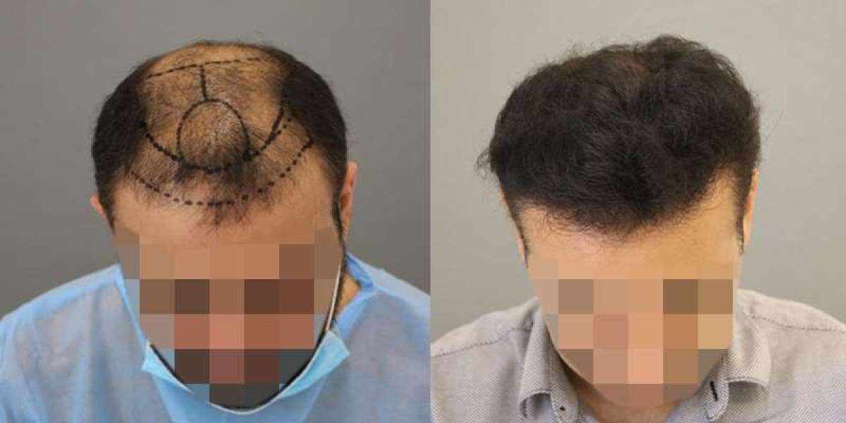 Decoding the Technology Behind a Hair Transplant in Riyadh