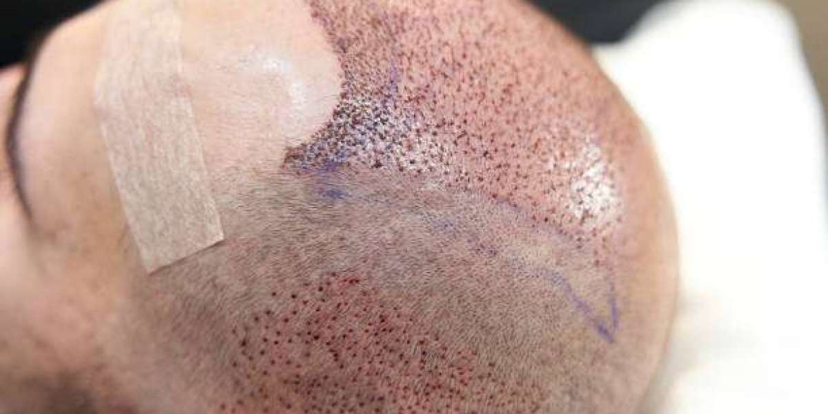 Preparing for Hair Transplant: Checklist for Best Outcomes