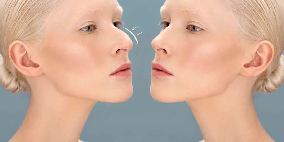 What to Expect in Your First Non-Surgical Rhinoplasty