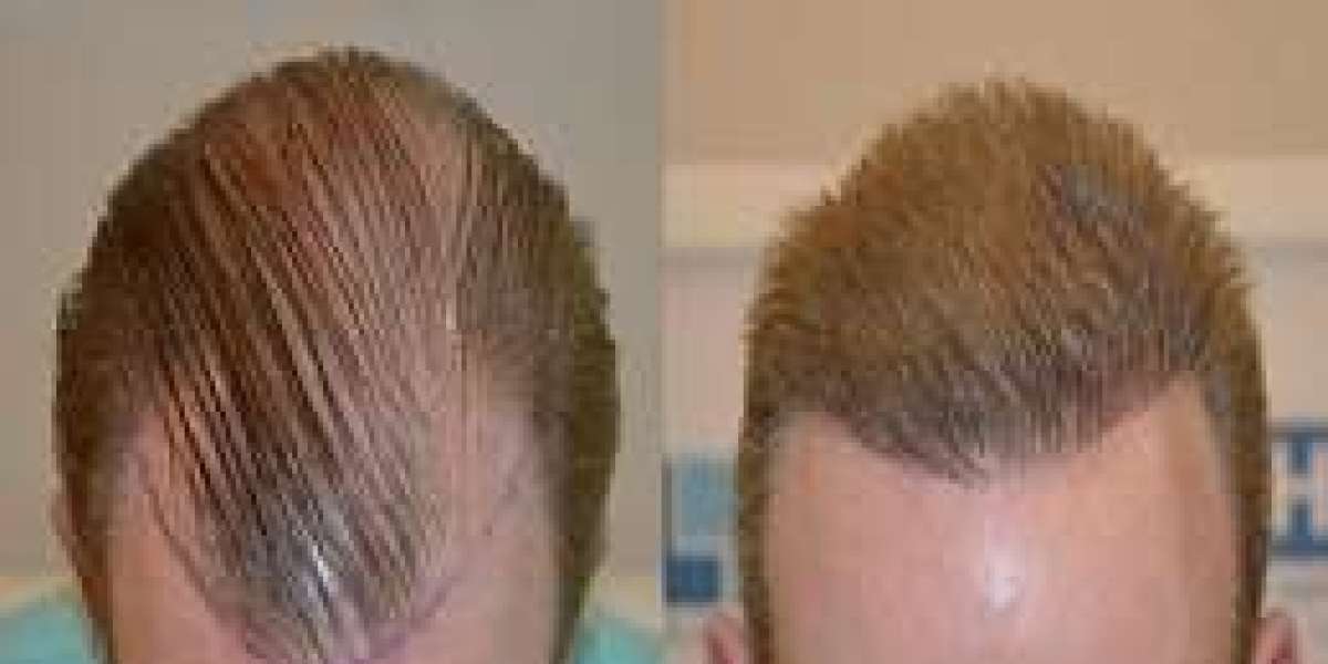 احذر من الأسعار الزهيدة لزراعة الشعر في دبي: الجودة أولاً