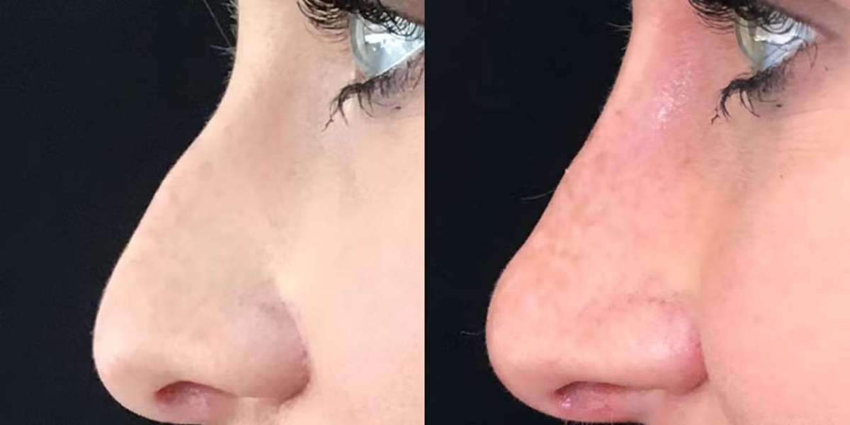 How to Find Best Rhinoplasty Surgeon for Nose Surgery Dubai