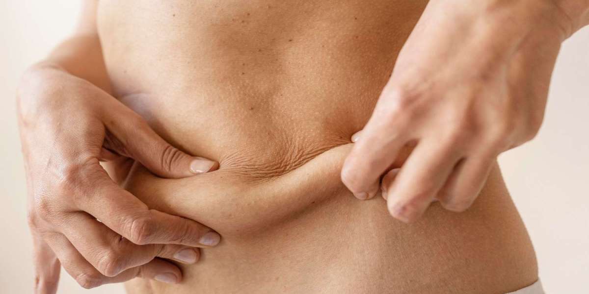 Liposuction Success Stories with the Best Doctors in Dubai