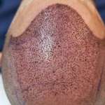 hairtransplant saudia Profile Picture