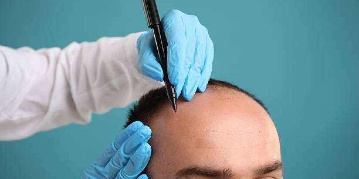 Hair Transplant Combining Therapies: When It’s Appropriate