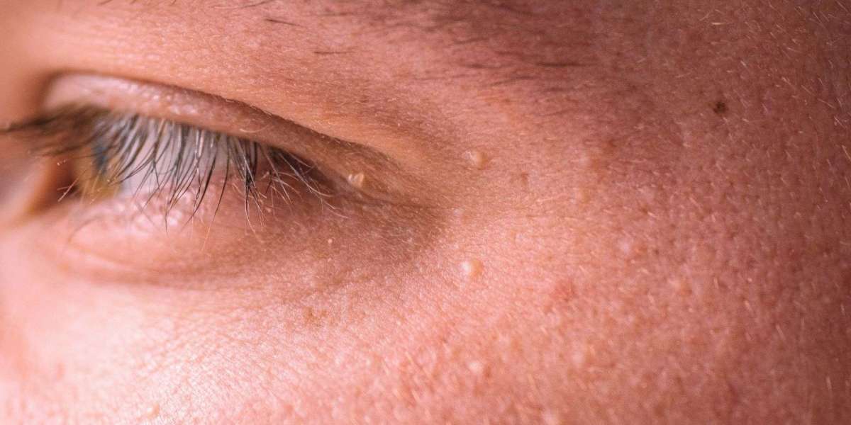 How Can Milia Treatment Support a Healthier Looking Complexion?