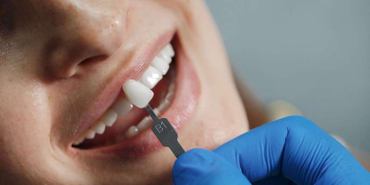 Dental Veneers Cost Dubai: Complete Guide to Achieving a Perfect Smile