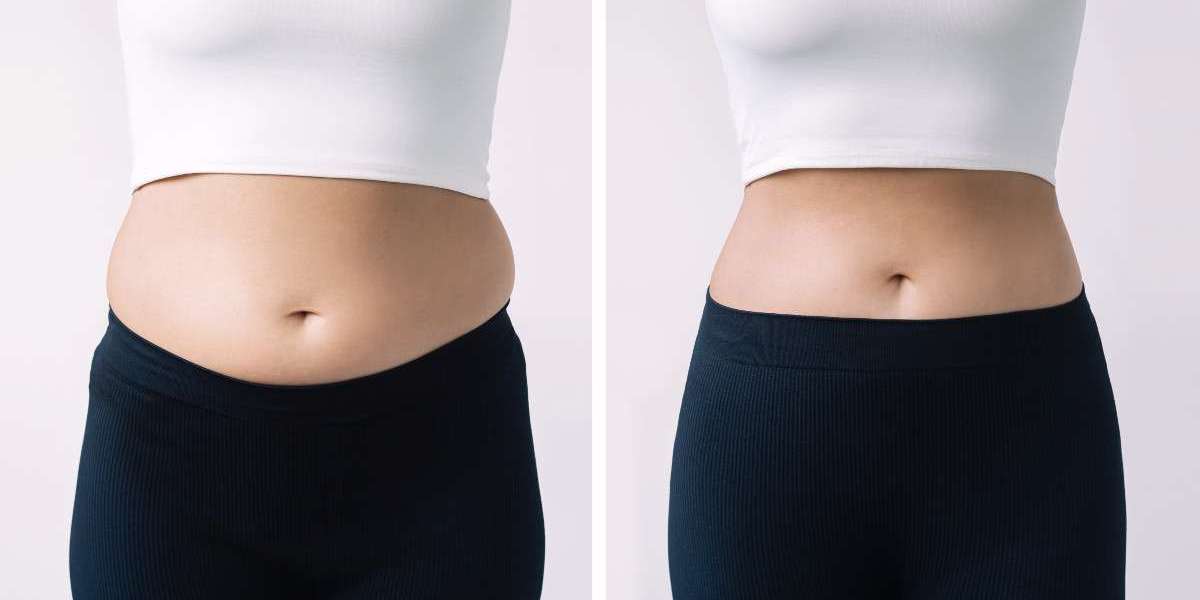 How Post Weight Loss in Islamabad Transforms Body Confidence