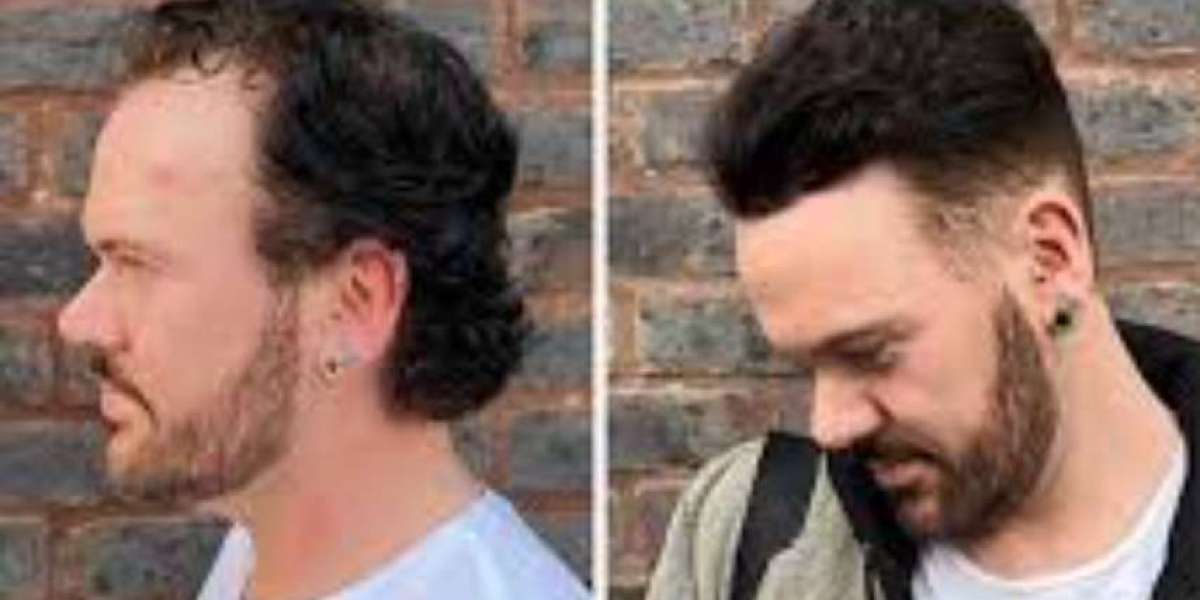 Hollywood Lace Hair Systems: A Modern Solution for Natural-Looking Hair Replacement