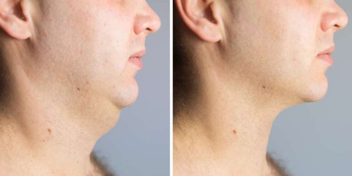 Natural-Looking Double Chin Removal in Dubai Results
