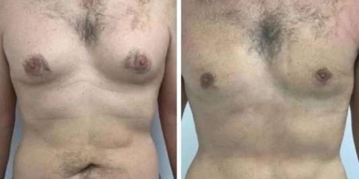 Best Gynecomastia Surgeons in Dubai: Everything You Need to Know Before Treatment