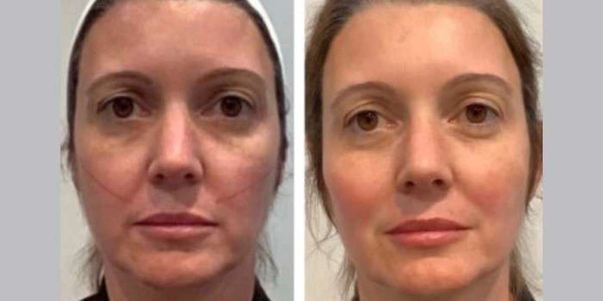 Best Aesthetic Clinic in Dubai Specializing in Safe Thread Lift Procedures