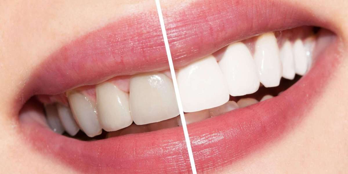 Why are my teeth still yellow after whitening?