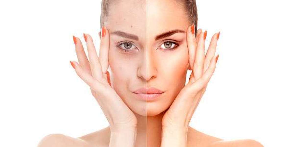 Can Wrinkle Smoothing Treatment in Dubai Create Smoother Skin?