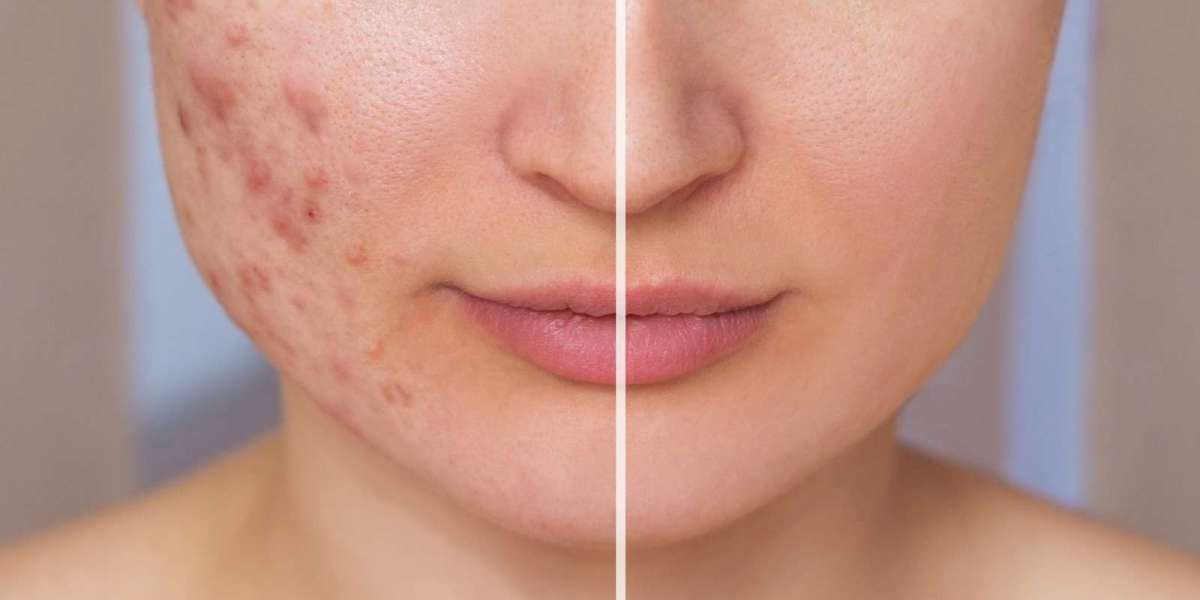 Advanced Laser Acne Scar Treatment in Riyadh for Skin Renewal Solutions