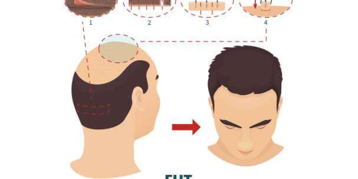 FUE Hair Transplant Procedure vs FUT Hair Transplant | MedLinks