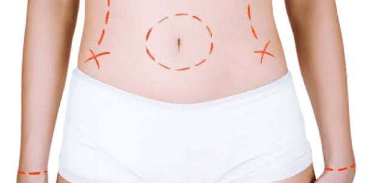 Mommy Makeover Dubai: Are You Ready? A Pre-Surgery Checklist