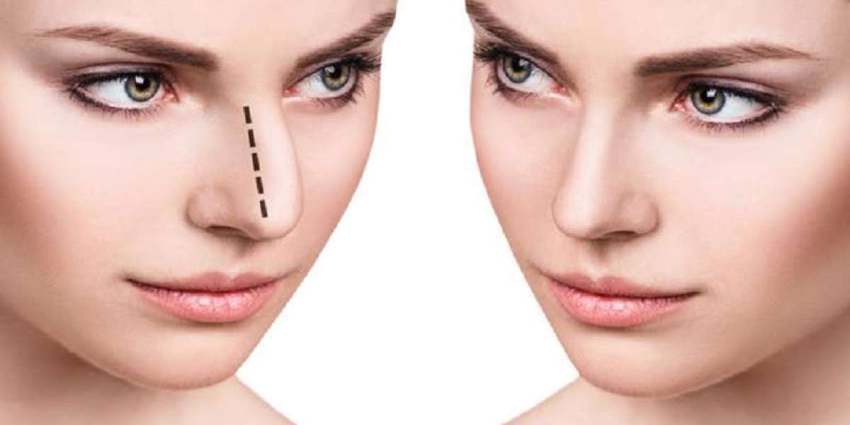كيف اخترت طبيبي لإجراء تجميل الأنف في الرياض؟ تجربة حقيقية