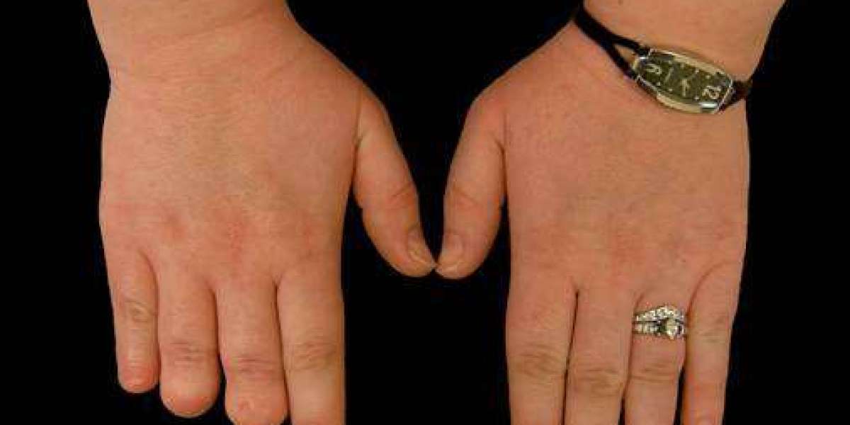 Finger Prosthetic Cost Myths: What Holds People Back Before They Even Ask
