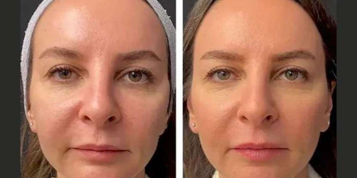 Best Aesthetic Clinic in Dubai for Mesotherapy for Acne Scars