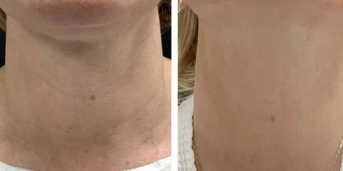Best Doctors in dubai for Radiofrequency Microneedling Skin Resurfacing