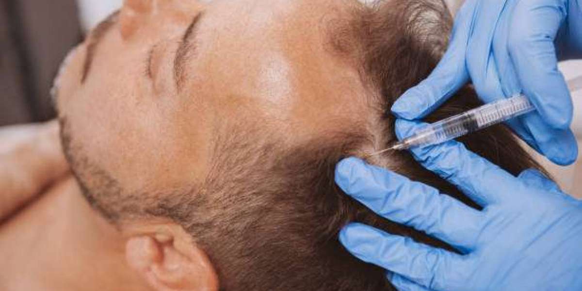Is GFC Hair Treatment in Dubai Suitable for Mild to Moderate Hair Loss?