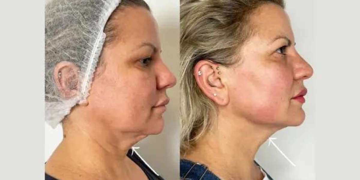 Best Aesthetic Clinic in dubai for Endolift Anti-Aging Treatments