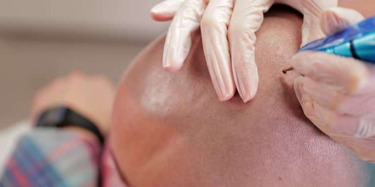 Scalp Micropigmentation in Dubai for Bald Patch Coverage