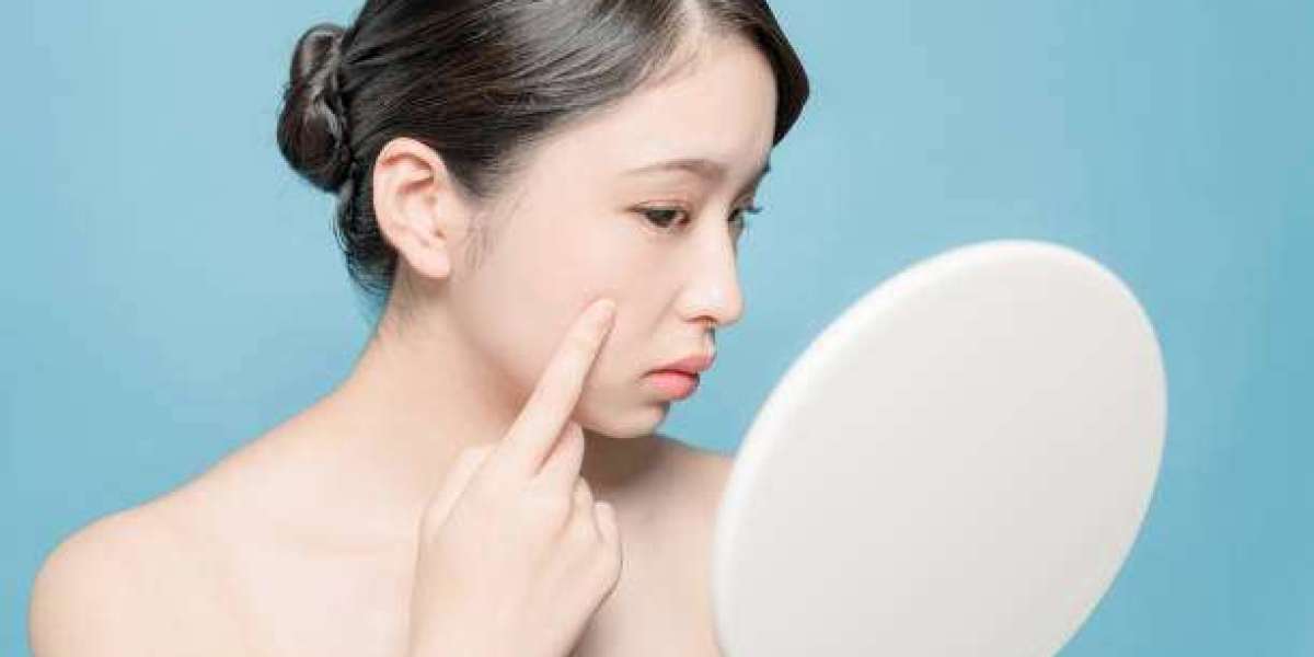 Pimples Treatment in Dubai for Breakouts From Harsh Cleansers