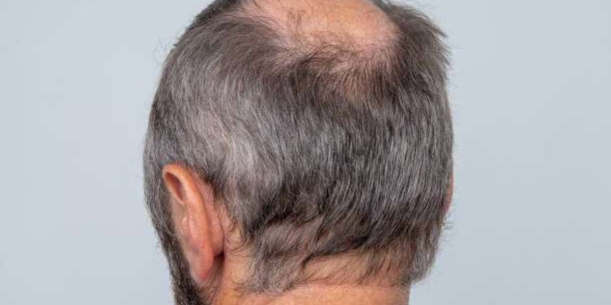Can FUE Hair Transplant in Dubai Restore Hair Around Scars?