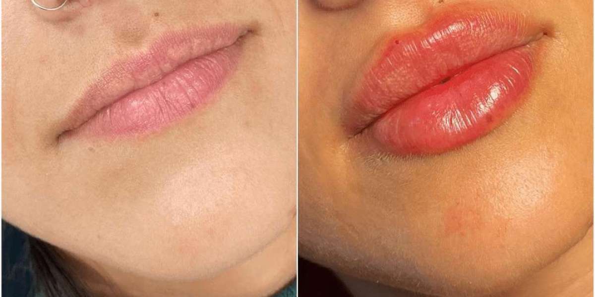 Juvederm Treatments for Men by Best Doctors in Dubai