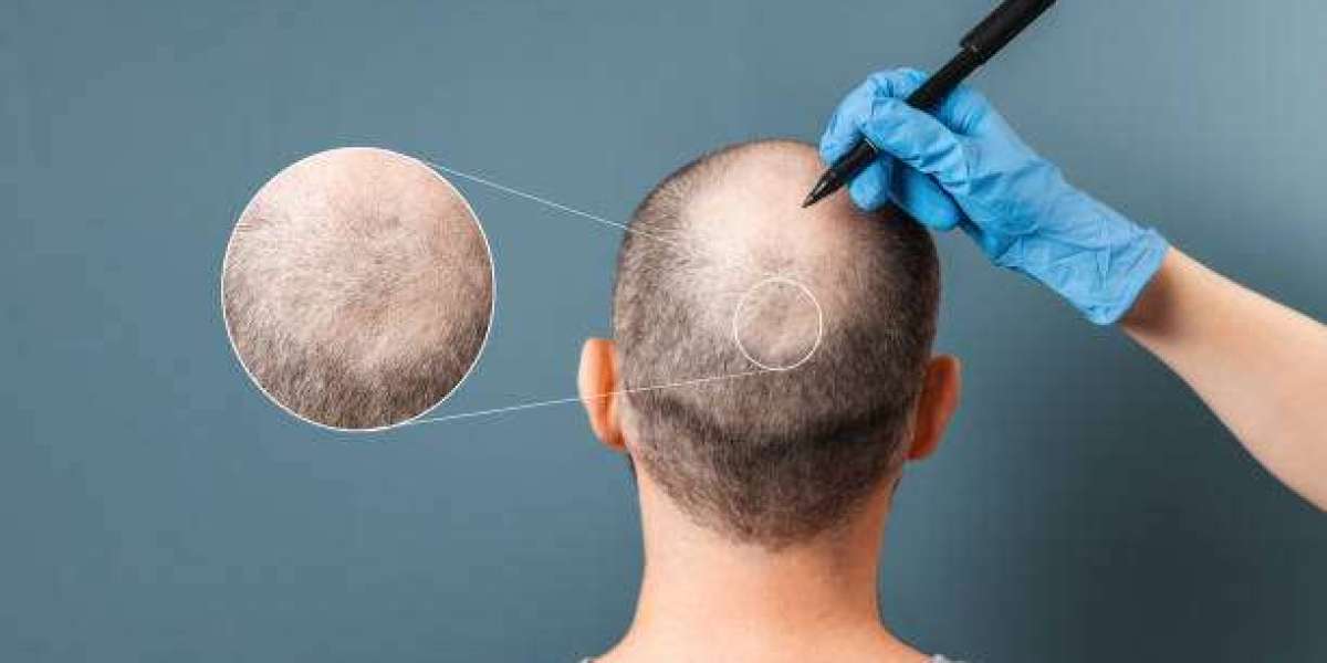 Crown Hair Transplant in Dubai: Can You Combine It With Hairline Restoration?