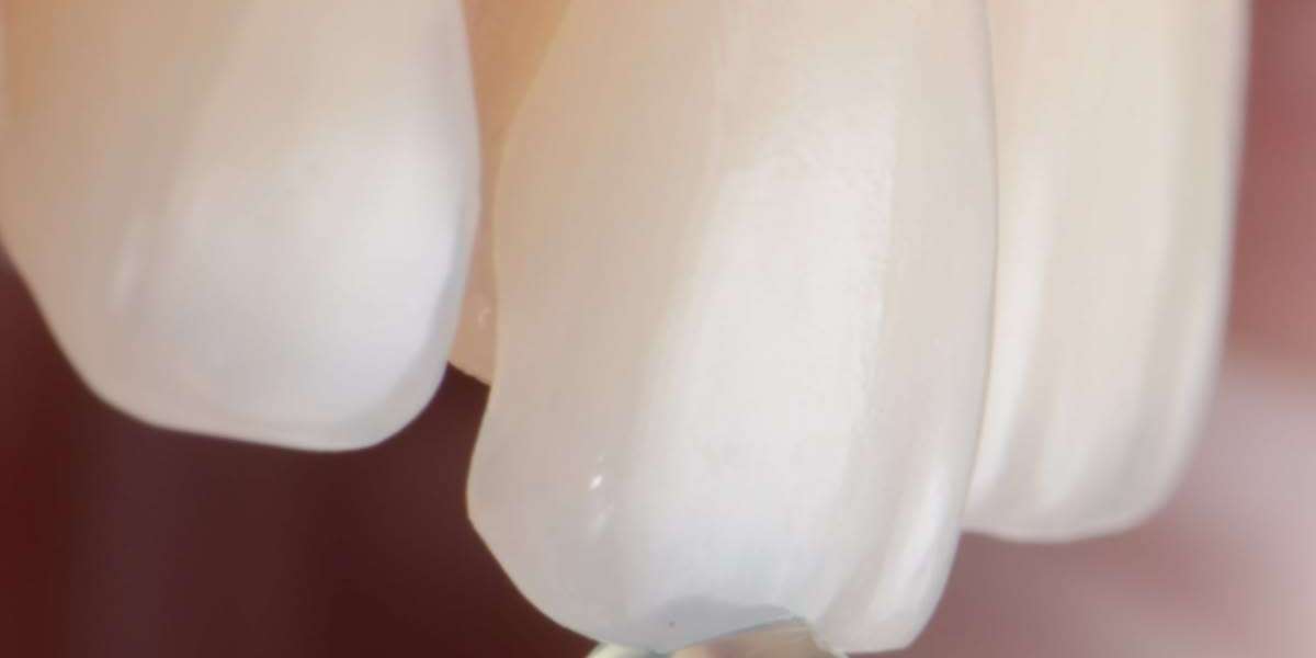 Why Consider Dental Veneers for Smile Enhancement?