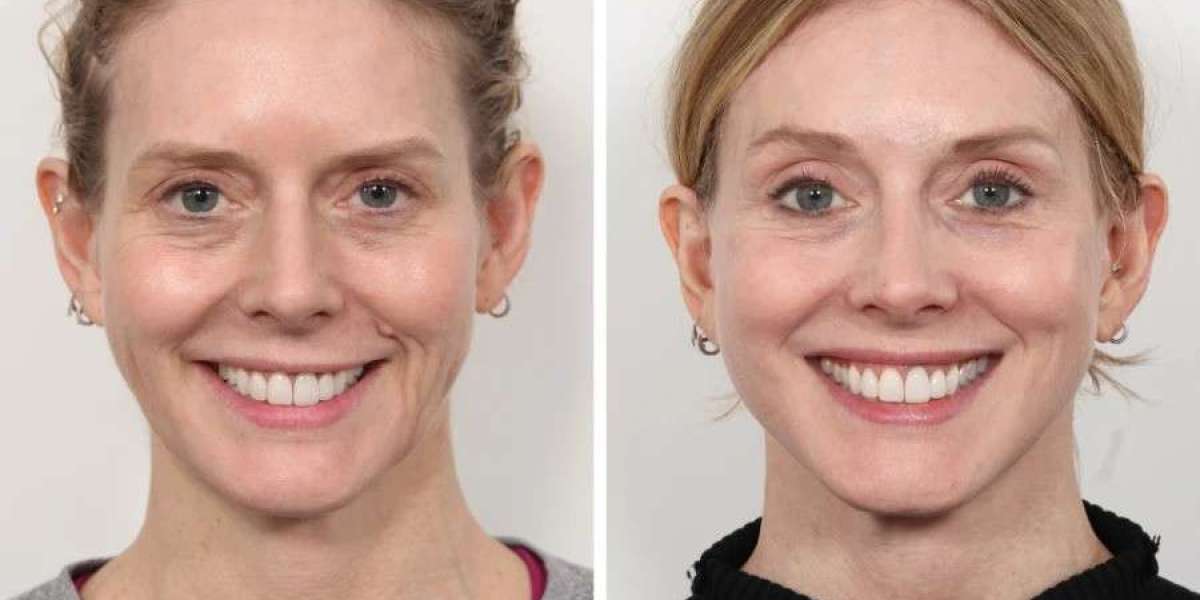Best Doctors in Dubai for Natural-Looking Thread Lift Results