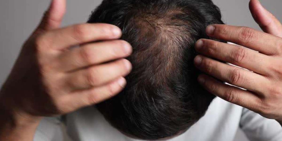What Factors Affect Stem Cell Hair Transplant Cost in Dubai?